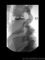 This x-ray of the lumbar spine was obtained during discography, a procedure where thin needles are placed through the skin and advanced into various lumbar disc spaces. About 2-3 ccs of dye is then injected into the disc, which can reproduce symptoms of pain and discomfort. The morphologic appearance of the contrast within the disc is also analyzed.