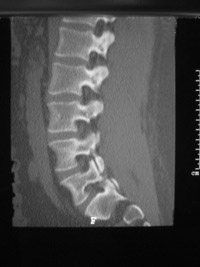 CT Scanning