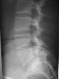 X-Ray